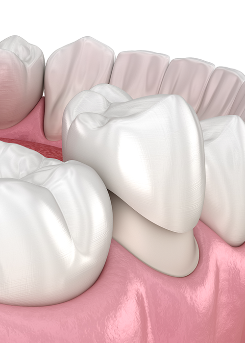 A 3D illustration of a crown being placed.